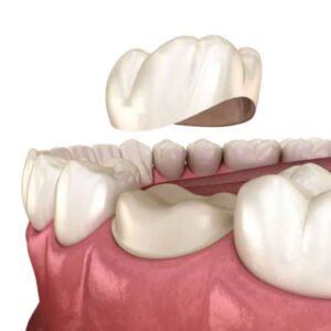 Corona de Porcelana y Metal Cerámica