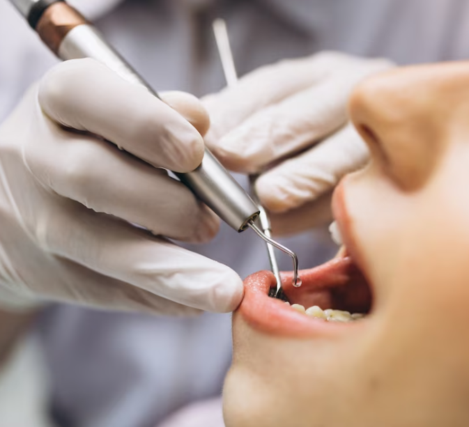 Endodoncia (Tratamiento de conducto)