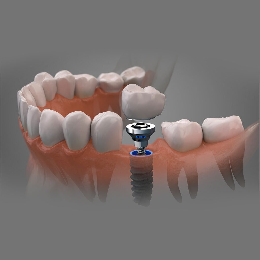 Implantes dentales