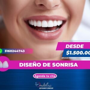 Diseño de sonrisa